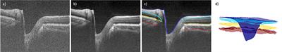 Age and Glaucoma-Related Characteristics in Retinal Nerve Fiber Layer and Choroid: Localized Morphometrics and Visualization Using Functional Shapes Registration